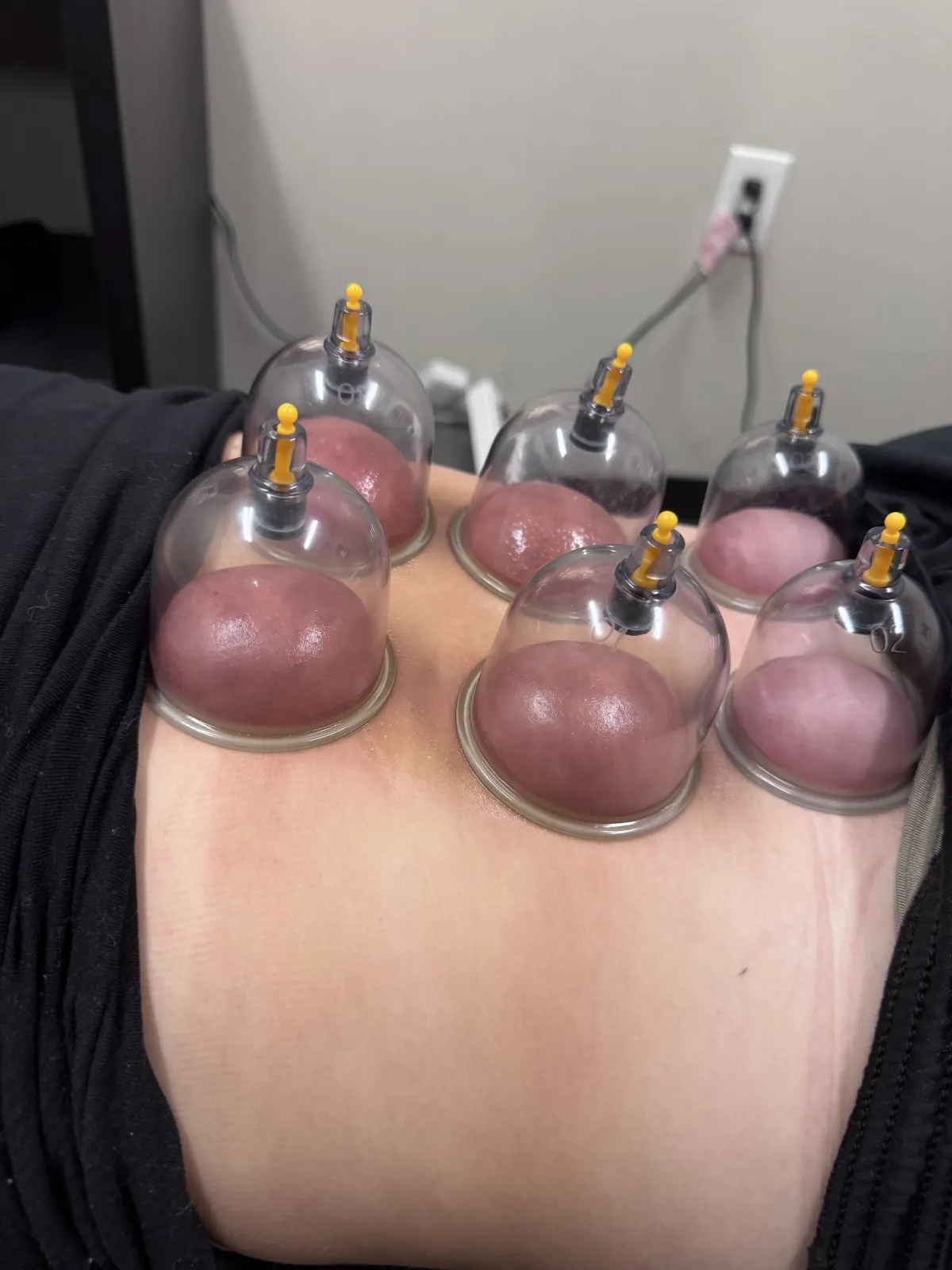 Cupping therapy applied to the lower back during a massage session in Bridgeton, Missouri